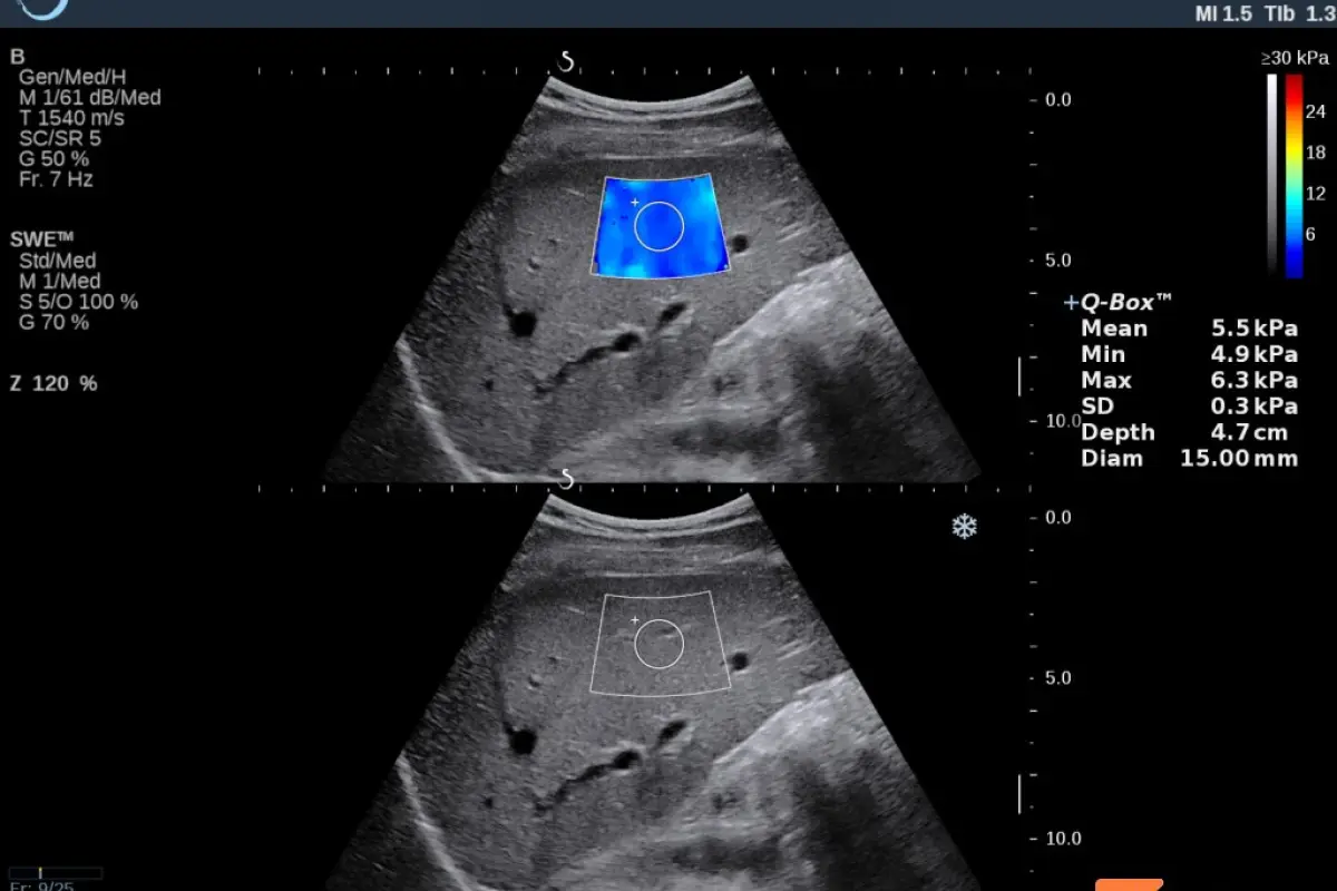 Screenshot of elastography examination — grade 1 fibrosis, healthy liver