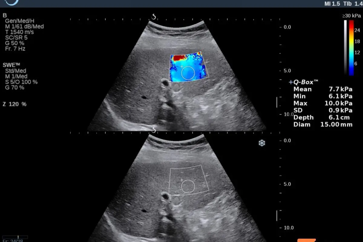 Screenshot of elastography examination — grade 2 fibrosis