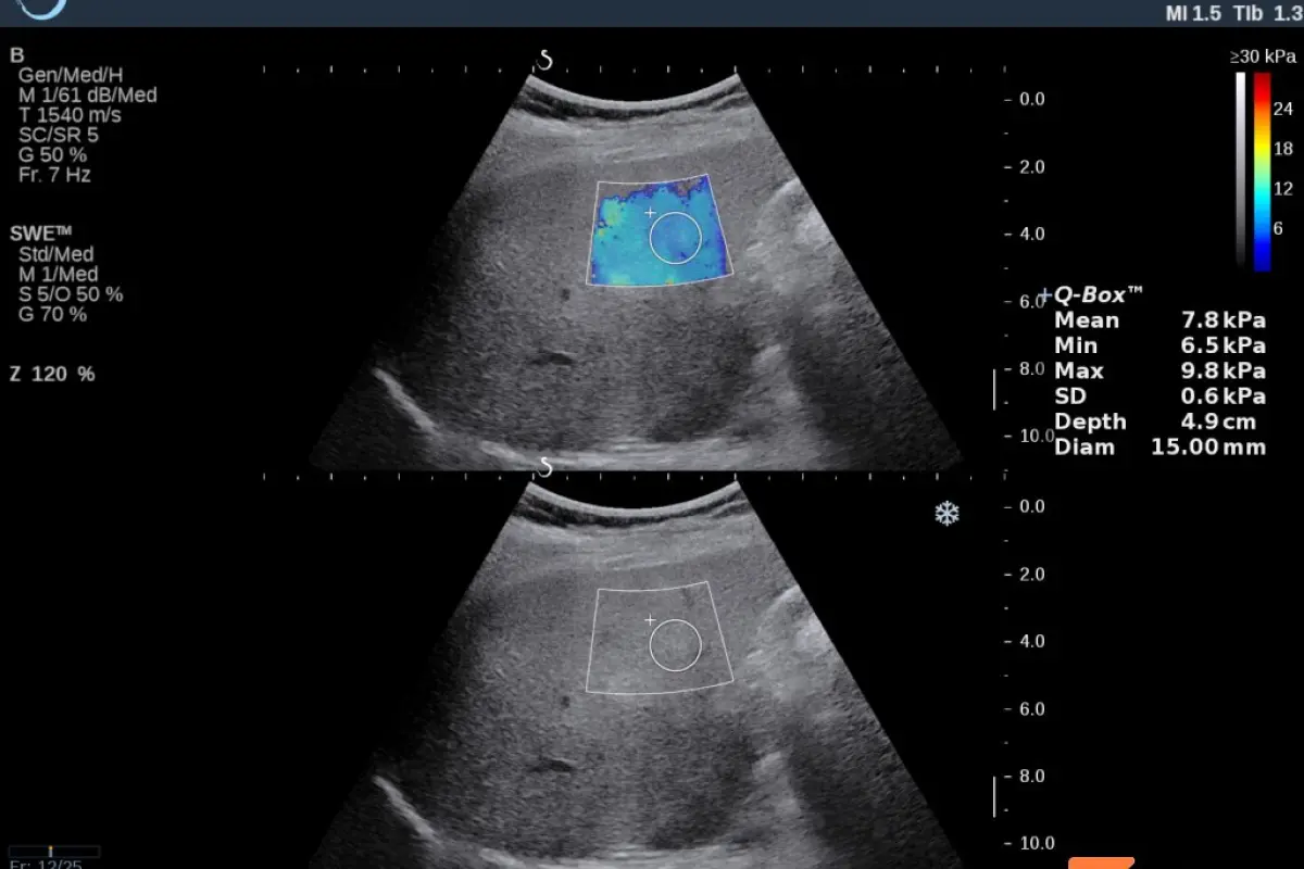Screenshot of elastography examination — grade 3 fibrosis