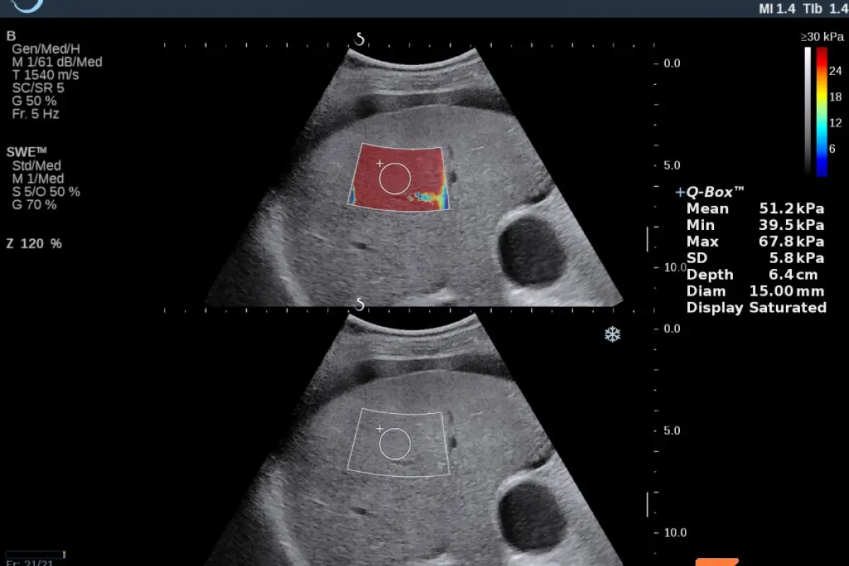 Screenshot of elastography examination — grade 4 fibrosis, liver with ascites
