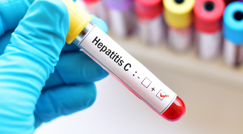 Hepatit C virusu (HCV) - əlamətləri, fəsadları və müalicəsi